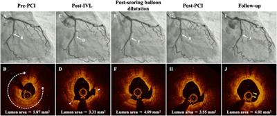 Case Report: Drug-coated balloon after intravascular lithotripsy for the treatment of severely calcified de novo coronary artery lesion